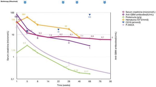 Pediatric double-seropositive anti-glomerular basement membrane antibody disease: A case report and literature review.