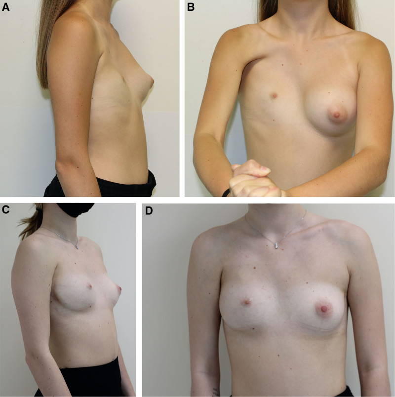 Surgical Algorithm of Poland Syndrome Based on Thorax, Breast, and Nipple-areola Complex Classification.