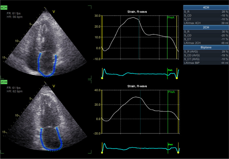 Left atrial function during exercise stress echocardiography as a sign of paroxysmal/persistent atrial fibrillation.