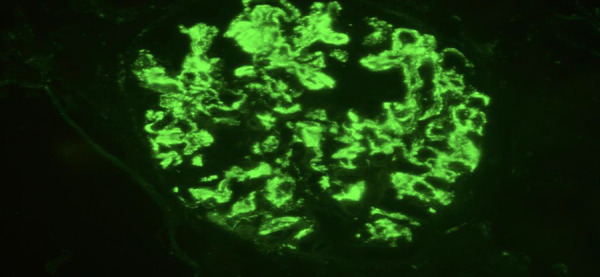 Pediatric double-seropositive anti-glomerular basement membrane antibody disease: A case report and literature review.