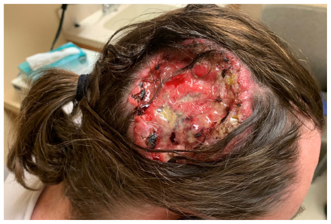A Diagnosis of Trichoblastic Carcinoma Using Immunohistochemistry.