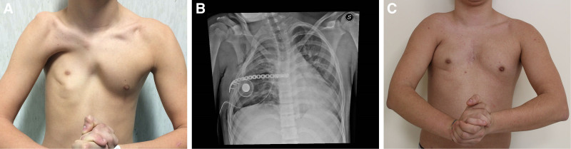 Surgical Algorithm of Poland Syndrome Based on Thorax, Breast, and Nipple-areola Complex Classification.
