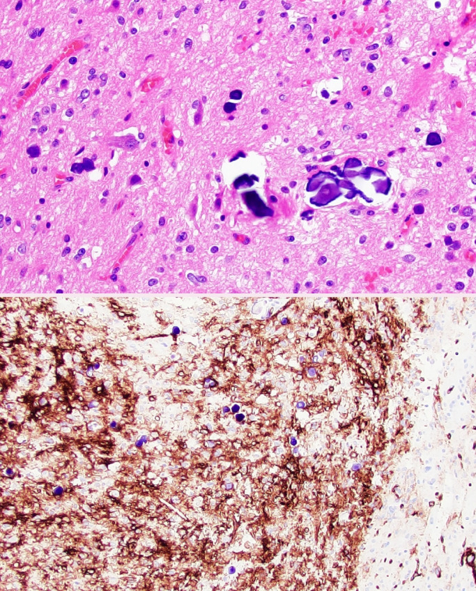 What's new in neuropathology 2024: CNS WHO 5th edition updates.