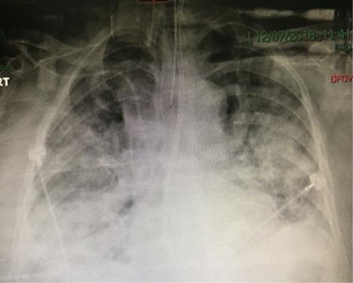 Ecthyma Gangrenosum of Fungal Origin: A Case Report.