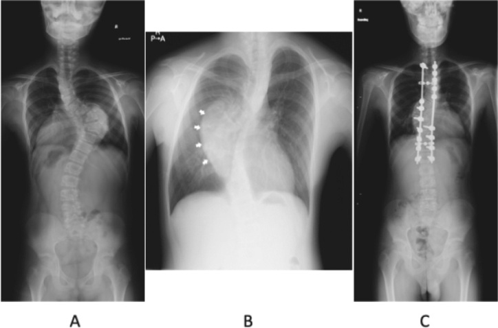 Adolescent thoracic scoliosis due to giant ganglioneuroma: a two-case report and literature review.