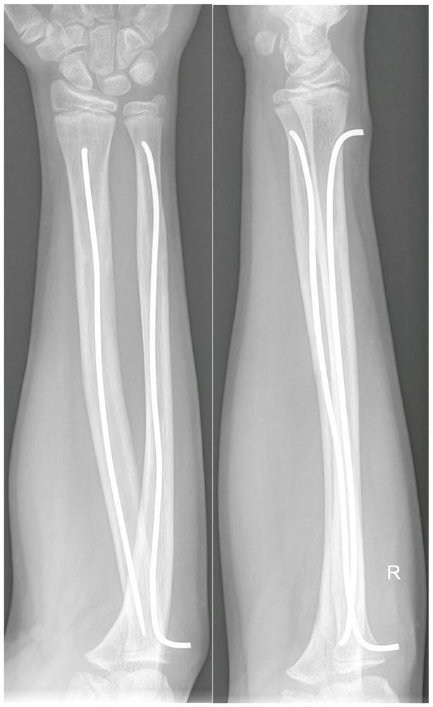 The effect of vitamin D on the speed and quality of pediatric fracture healing.