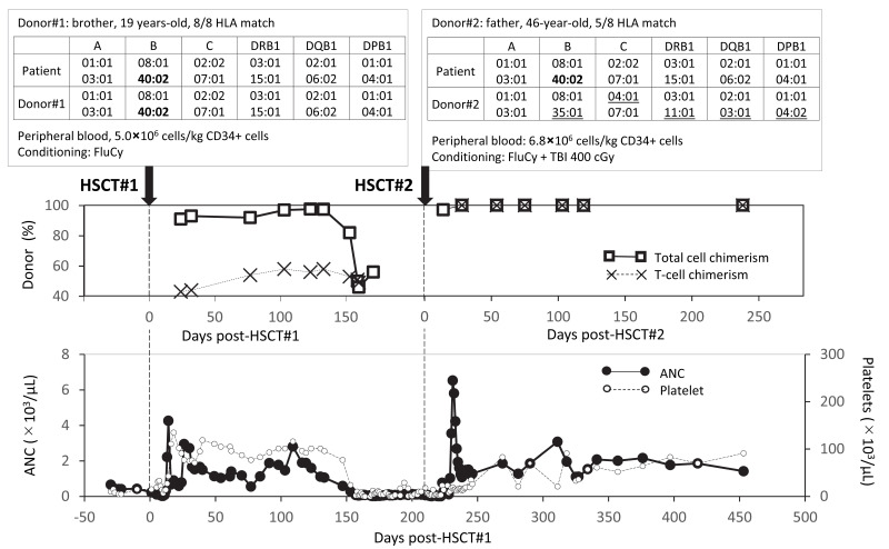 Recurrent disease after a matched sibling hematopoietic transplant in an aplastic anemia patient with a disease risk allele, HLA-B*40:02.