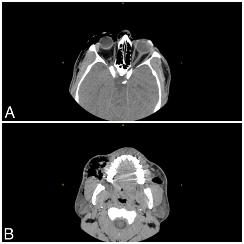 Orbital and Premaxillary Emphysema as a Result of Nose-Blowing Following Blepharoplasty.