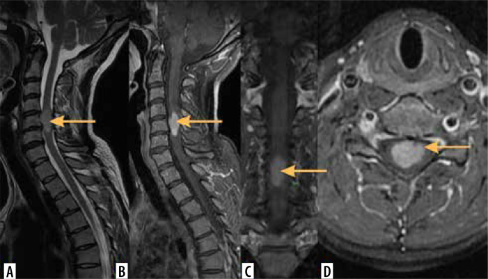 Imaging of intramedullary tumours of the spinal cord.