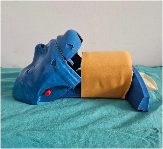 Comparison of bougie-guided cricothyrotomy and traditional cricothyrotomy techniques in an obese 3D-printed surgical airway manikin: a randomized controlled study.