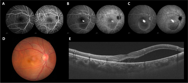 A clinical study on the therapeutic effects of 577 nm micropulse laser photocoagulation treatment in early-stage CSCR patients.