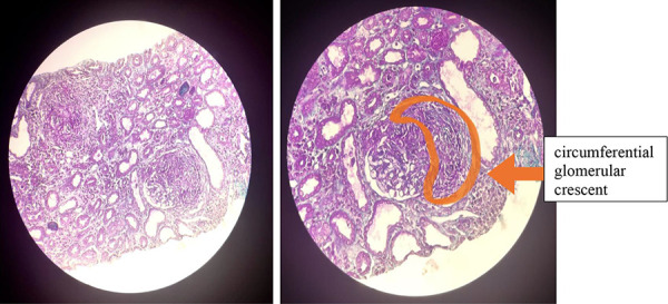 Pediatric double-seropositive anti-glomerular basement membrane antibody disease: A case report and literature review.