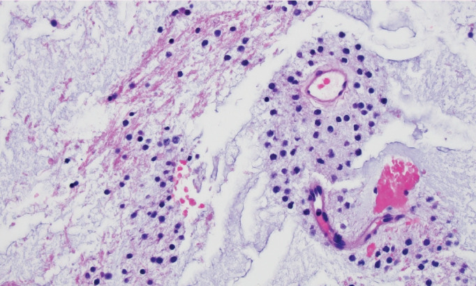 What's new in neuropathology 2024: CNS WHO 5th edition updates.