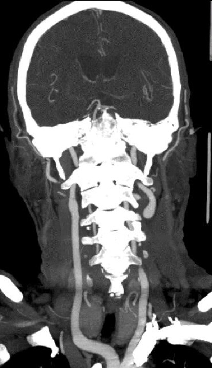 Recurrent Ischaemic Stroke Secondary to Cerebral Small Vessel Vasculopathy From Clonal B-Cell Lymphomatosis of Marginal Zone Origin.