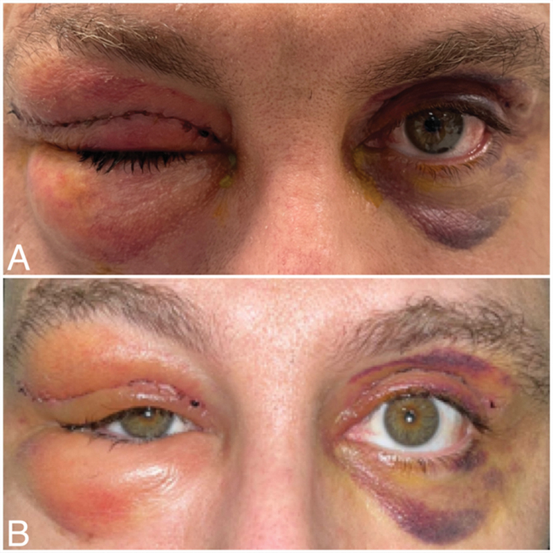 Orbital and Premaxillary Emphysema as a Result of Nose-Blowing Following Blepharoplasty.