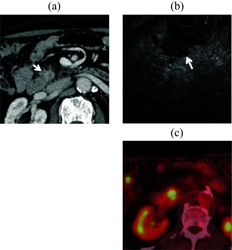 Pylorus-preserving pancreatoduodenectomy preserving blood supply for pancreatic cancer with a history of proximal gastrectomy and sigmoidectomy: a case report.
