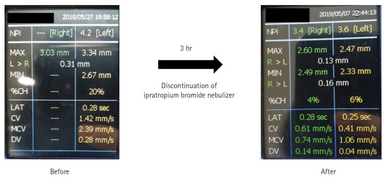 Isolated reversible mydriasis was associated with the use of nebulized ipratropium bromide: a case series using quantitative pupilometer in Korea.