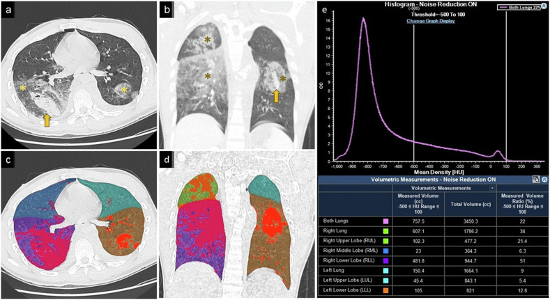 Predicting life-threatening hemoptysis in traumatic pulmonary parenchymal injury using computed tomography semi-automated lung volume quantification.