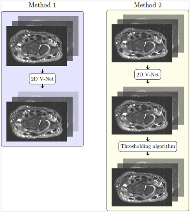 Automatic segmentation of extensor carpi ulnaris tendon and detection of tendinosis with convolutional neural networks.