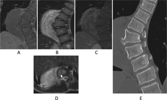 Adolescent thoracic scoliosis due to giant ganglioneuroma: a two-case report and literature review.