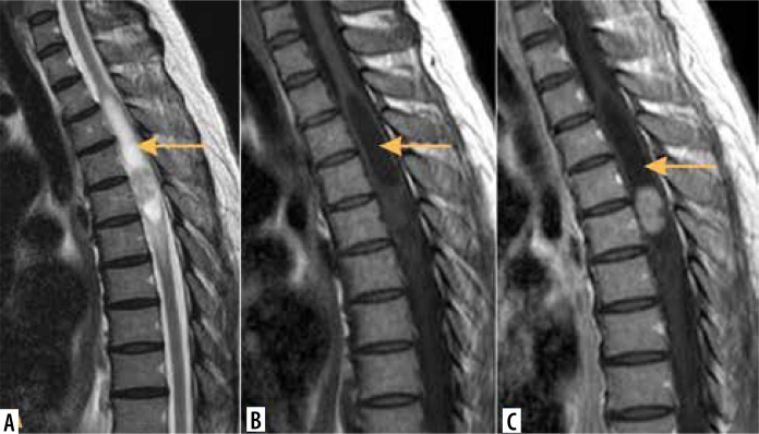 Imaging of intramedullary tumours of the spinal cord.