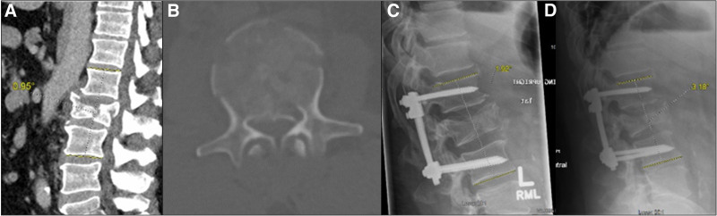 The neurologically intact patient with TLICS 4 or 5 burst fracture should be given a trial of nonoperative management.