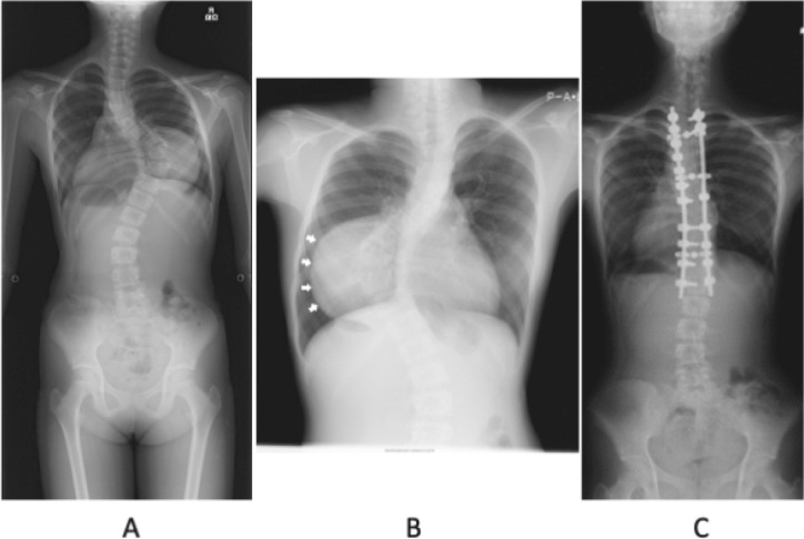 Adolescent thoracic scoliosis due to giant ganglioneuroma: a two-case report and literature review.
