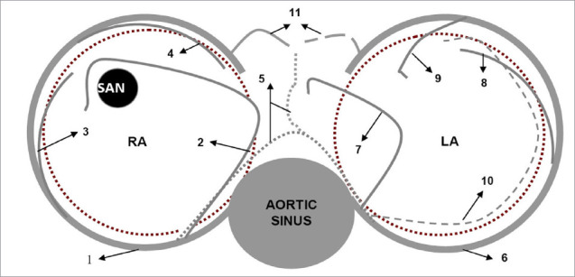 A Comprehensive Review of Atrial Infarction.