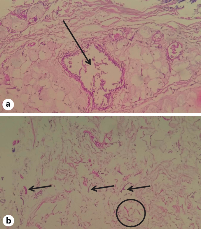 Ecthyma Gangrenosum of Fungal Origin: A Case Report.