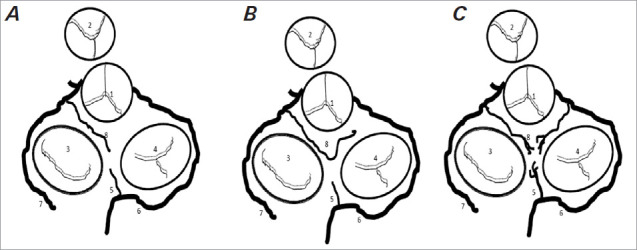 A Comprehensive Review of Atrial Infarction.