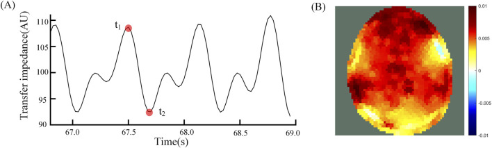 Evaluation of cerebral perfusion heterogeneity by the electrical impedance tomography.