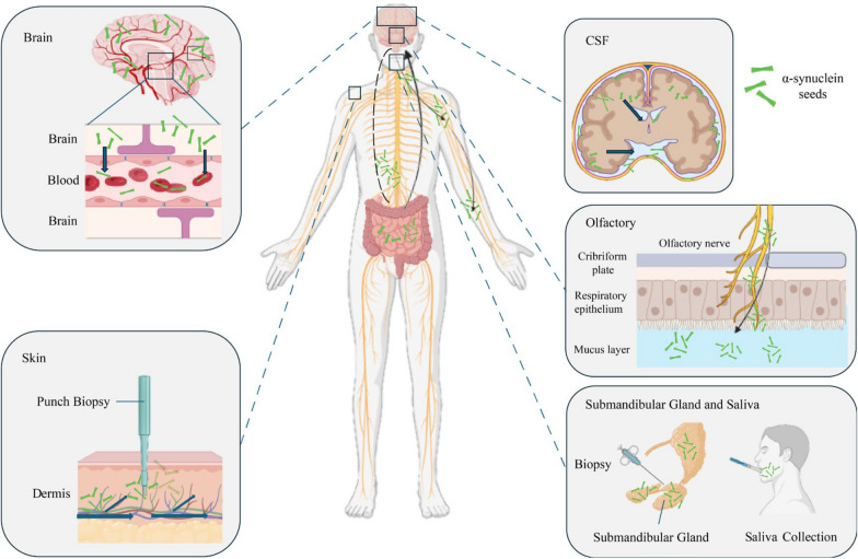 α-Synuclein seeding amplification assays for diagnosing synucleinopathies: an innovative tool in clinical implementation.