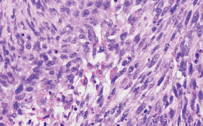 What's new in neuropathology 2024: CNS WHO 5th edition updates.
