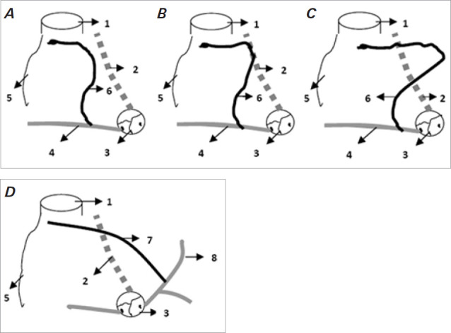 A Comprehensive Review of Atrial Infarction.