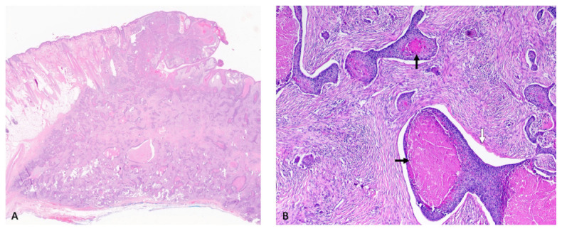 A Diagnosis of Trichoblastic Carcinoma Using Immunohistochemistry.