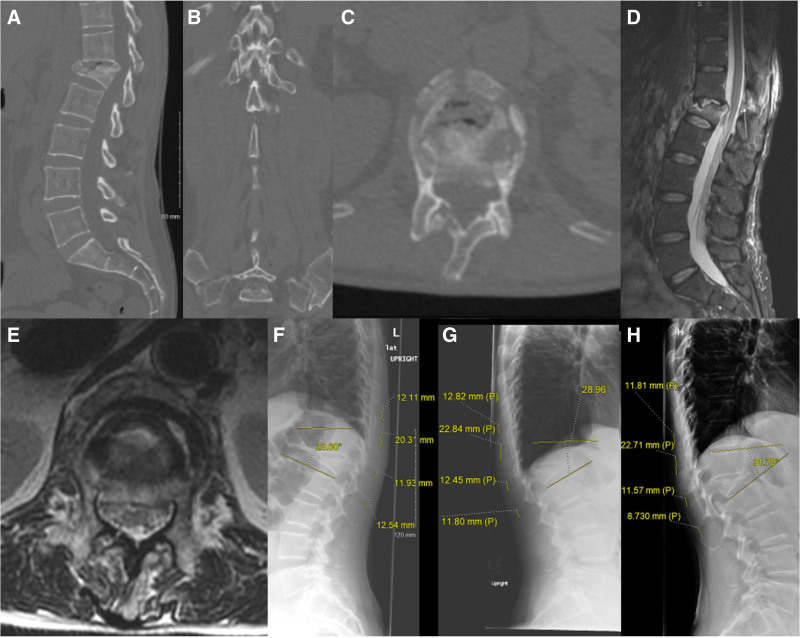 The neurologically intact patient with TLICS 4 or 5 burst fracture should be given a trial of nonoperative management.