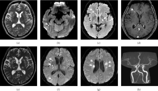 Recurrent Ischaemic Stroke Secondary to Cerebral Small Vessel Vasculopathy From Clonal B-Cell Lymphomatosis of Marginal Zone Origin.
