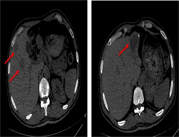 Combined coronary artery bypass grafting and orthopedic fixation in a patient with multiple comorbidities: a case report.