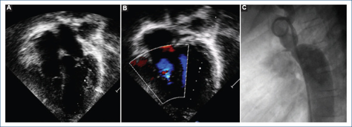 [Percutaneous treatment of aortic coartation and ductus arteriosus in a patient with Ebstein's anomaly].