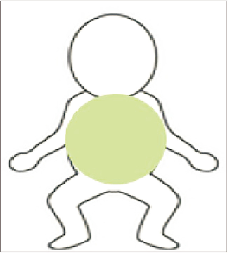 Effectiveness and safety of chlorhexidine gluconate double-cleansing for surgical site infection prevention in neonatal intensive care unit surgical patients.