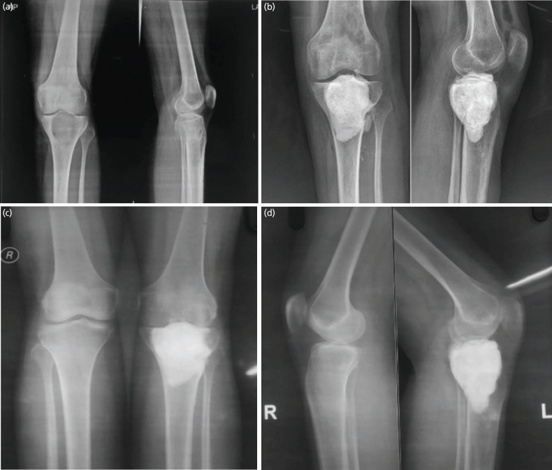Long-term Functional Outcomes of Giant Cell Tumours around the Knee treated by Extended Curettage followed by Bone Grafting, Cementation, or a Combination.