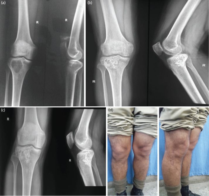 Long-term Functional Outcomes of Giant Cell Tumours around the Knee treated by Extended Curettage followed by Bone Grafting, Cementation, or a Combination.