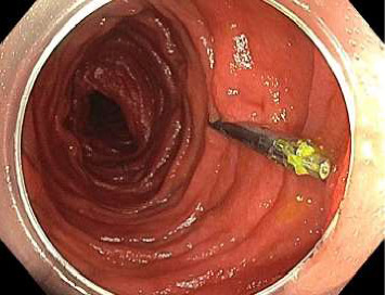 Jejunal Diverticular Bleeding on Long-Term Aspirin and Short-Term Corticosteroid Therapy.