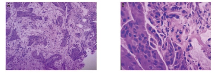 [A Case Report of EGFR-TKIs Resistant Secondary MET Gene Amplified  Lung Squamous Cell Carcinoma and Literature Review].