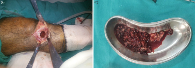 Long-term Functional Outcomes of Giant Cell Tumours around the Knee treated by Extended Curettage followed by Bone Grafting, Cementation, or a Combination.