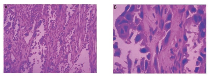 [A Case Report of EGFR-TKIs Resistant Secondary MET Gene Amplified  Lung Squamous Cell Carcinoma and Literature Review].
