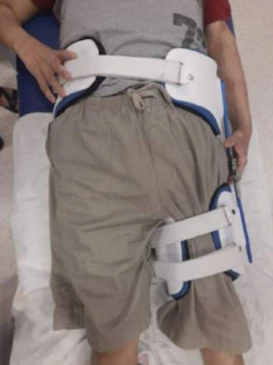Functional Bracing in a Femur Non-union Following Fracture Related Infection: A Case Report.