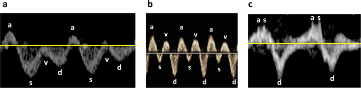 Correlation between right atrial pressure measured via right heart catheterization and venous excess ultrasound, inferior vena cava diameter, and ultrasound-measured jugular venous pressure: a prospective observational study.
