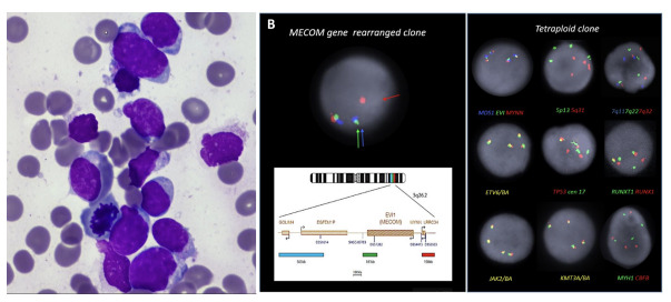 Untangling the clonal architecture in a case of acute myeloid leukaemia with multiple cytogenetically unrelated clones.