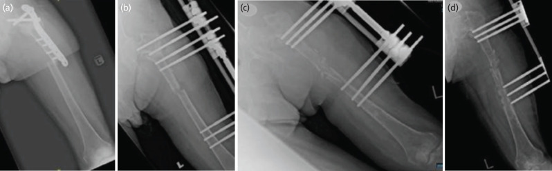 Functional Bracing in a Femur Non-union Following Fracture Related Infection: A Case Report.